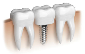 Illustration of three teeth on gums, with the middle tooth replaced by a metal dental implant.