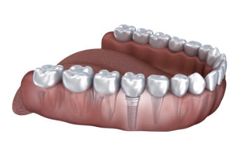 Illustration of a lower jaw with teeth and a visible dental implant on the right side.
