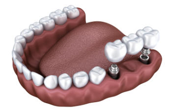 implant supported dental bridge