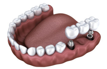3D illustration of dental implants in a lower jaw, showing two metal posts supporting crowns among natural teeth.