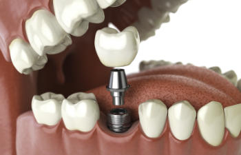 Illustration of a dental implant procedure showing a crown being placed onto an implant post within a model of the mouth.