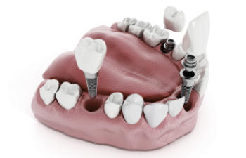 Dental model showing implants and natural teeth, with a focus on dental procedures and reconstruction.