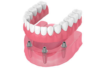 All-on-4 dental implants