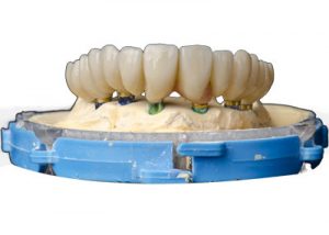 Full Mouth Reconstruction Dental Model