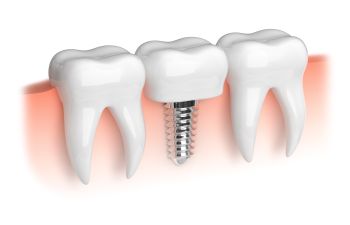 Illustration of two teeth and a dental implant with a crown, set against a stylized gum background.