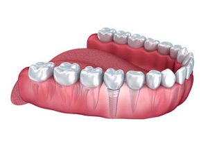Illustration of a lower dental arch with teeth, including a dental implant replacing a missing tooth, shown embedded in the gum.