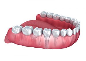 Single Tooth Dental Implant