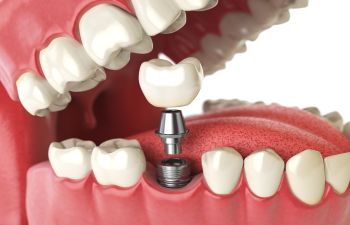Illustration of a dental implant being placed in the lower jaw, showing the implant post and abutment beneath a removable artificial tooth.