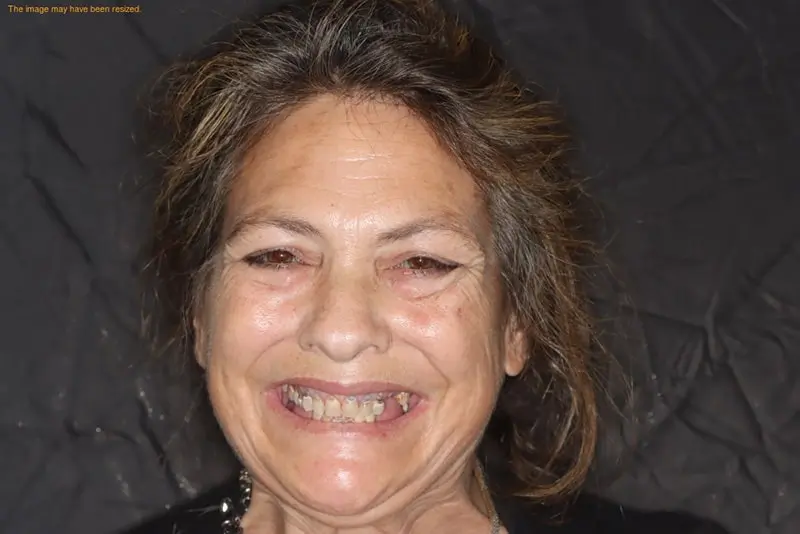 Smiling older woman with missing teeth against a dark background.