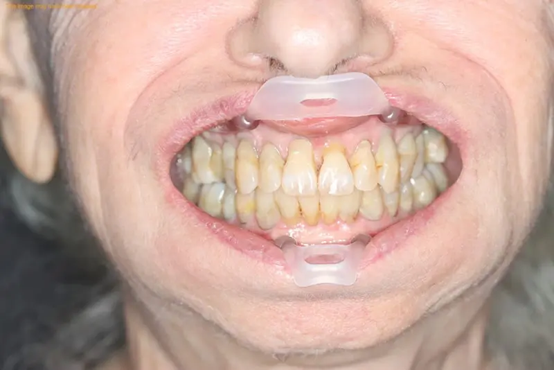 Close-up of a person's mouth open with dental retractors, showing discolored teeth.