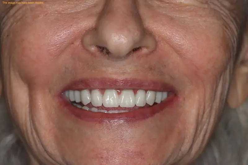 Close-up of a person's smile showing white, even teeth and part of the nose.