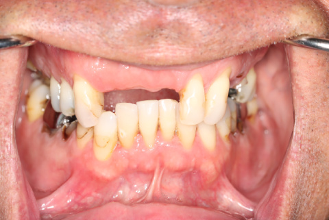 male patient after all on 4 dental implants procedure