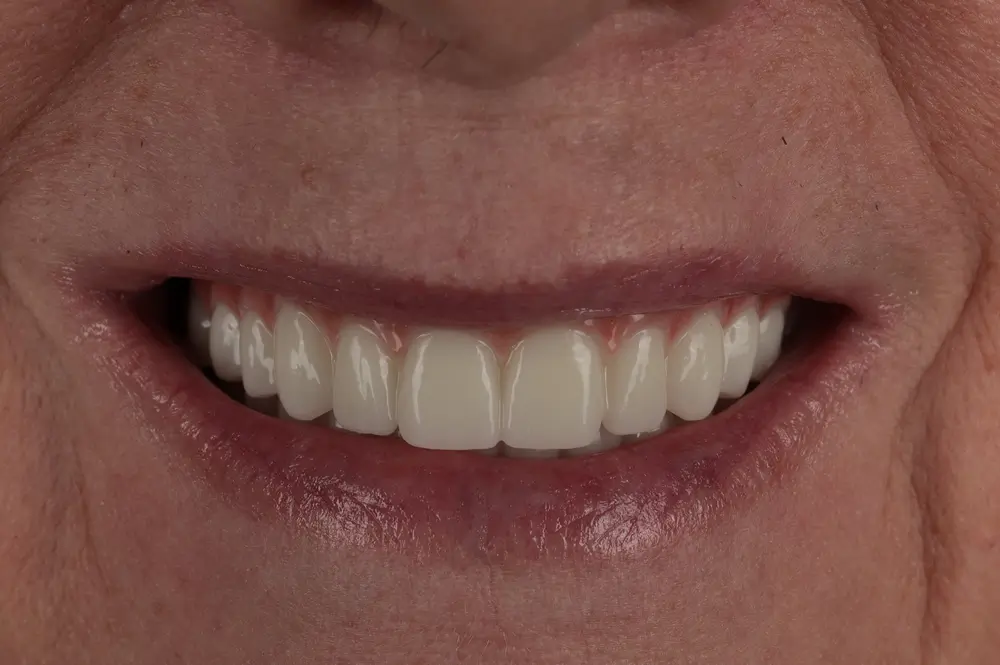 Close-up of a person smiling, showing their teeth.