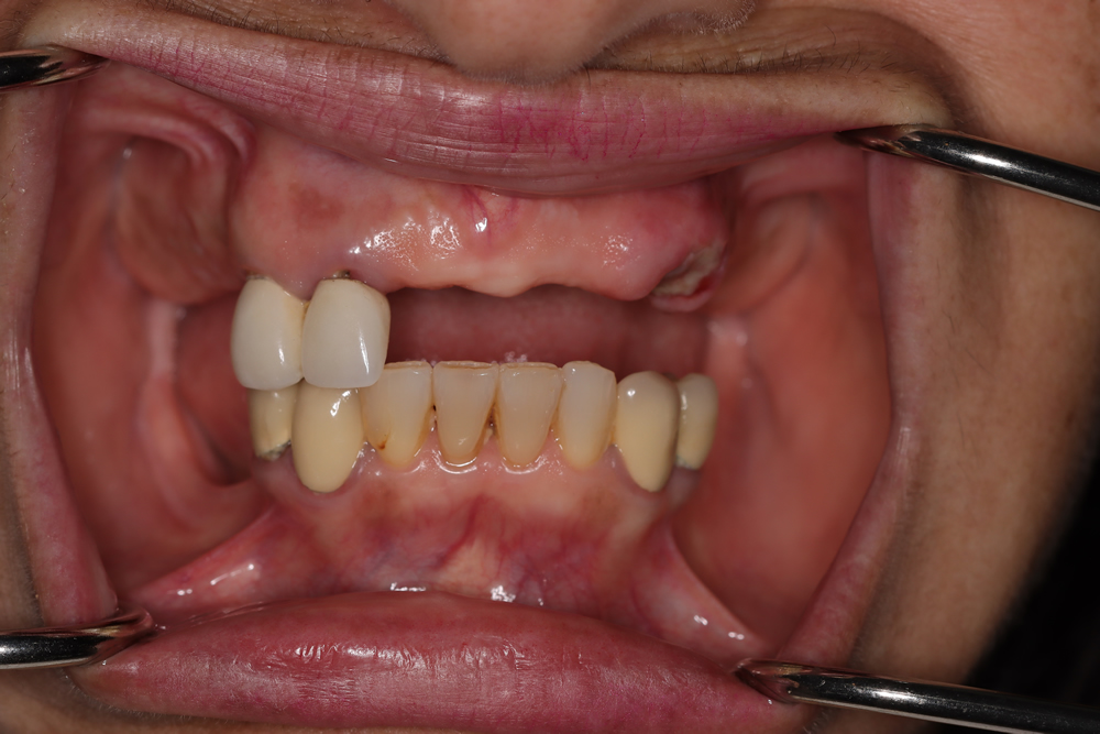 female patient before all on 4 dental implants procedure