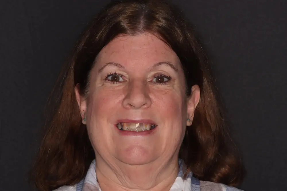 A woman with brown hair smiles, showing missing upper teeth, against a dark background.