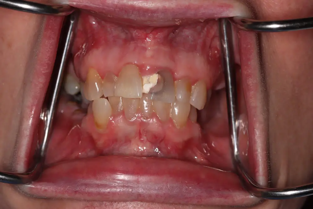 Close-up of a mouth with dental retractors showing upper and lower teeth. The front upper teeth are discolored and misaligned, with visible gaps and signs of decay.