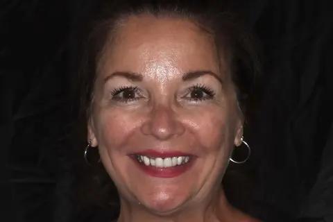 female patient after all on 4 dental implants procedure