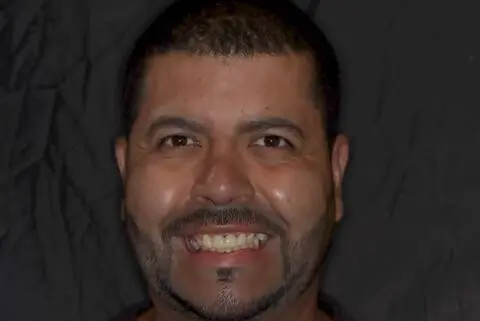 male patient before all on 4 dental implants procedure
